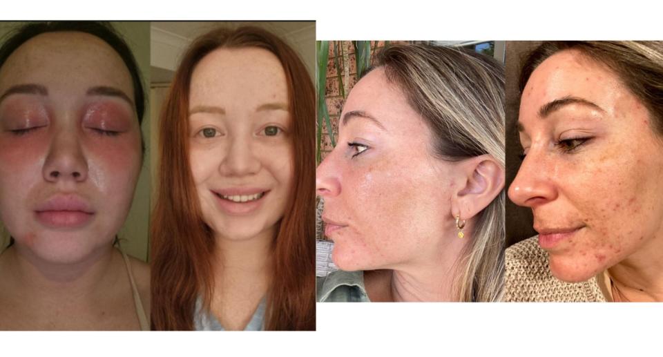 Before and after photos of skin showing improvement in inflamed and acne-prone skin