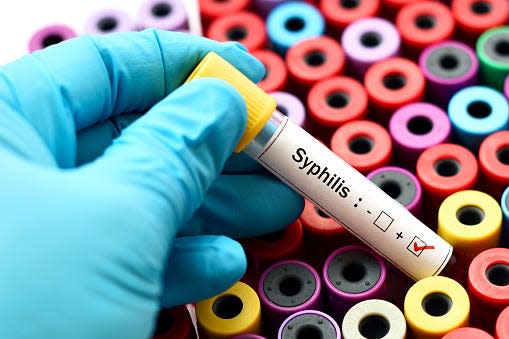 This blood sample is positive for syphilis. In Texas, from 2013 to 2022, early stage adult syphilis went from 534 cases a year to 3,125, and congenital syphilis annual cases went from 73 to 922.