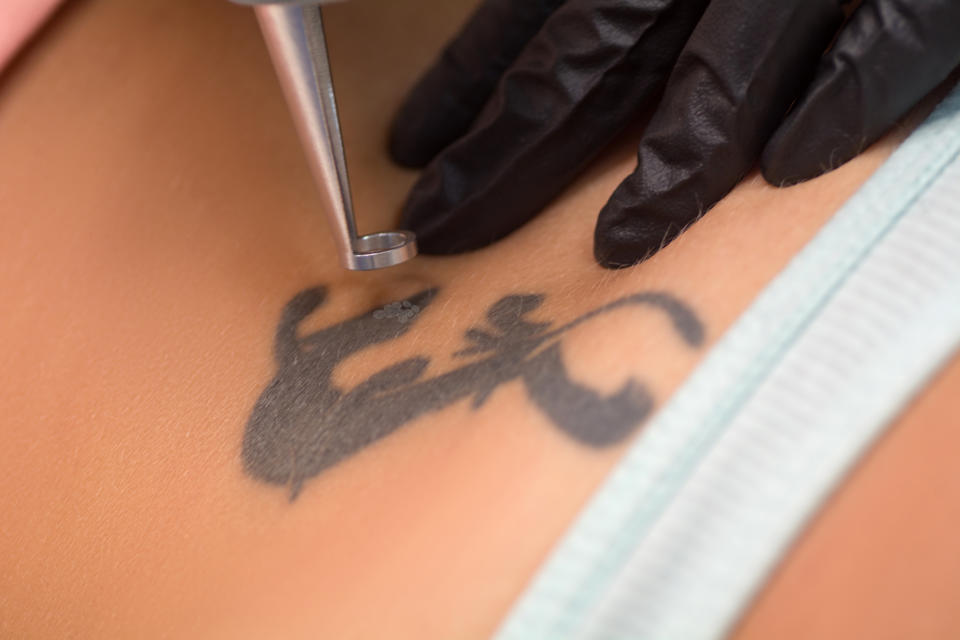 Laser tattoo removal procedure. Salon equipment