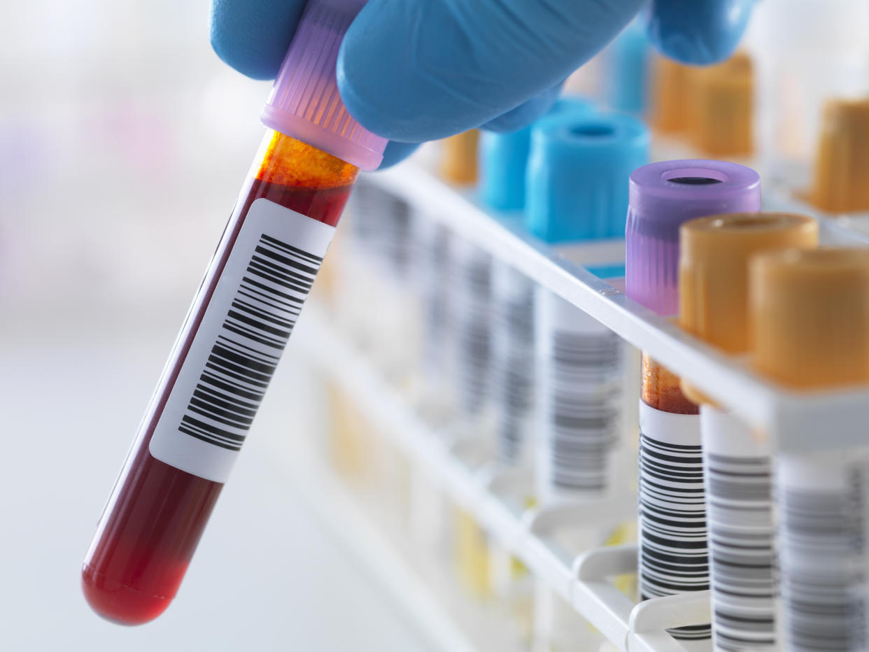 A blood sample being held with a row of human samples for analytical testing including blood, urine, chemistry, proteins, anticoagulants and HIV in lab