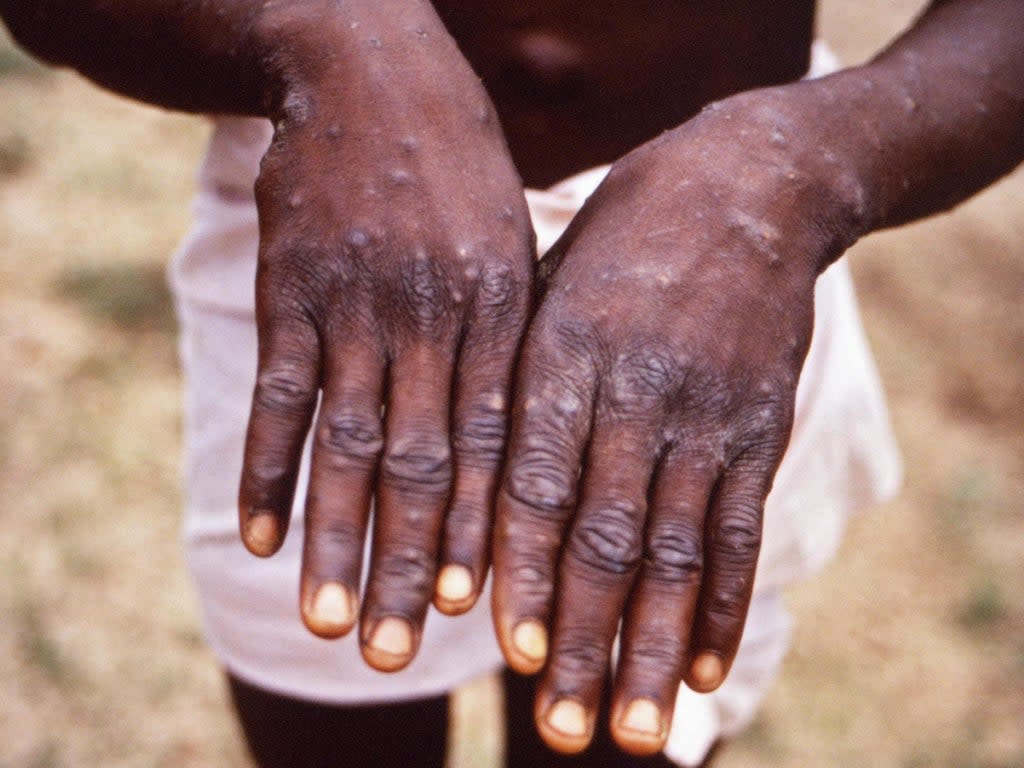 Monkeypox is a rare viral infection that does not spread easily between people (Alamy)