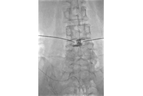 慢性椎間盤疼痛可於手術室放射線顯影下，以射頻進行椎間盤修復術來降低疼痛。（圖片／簡吉聰醫師提供）