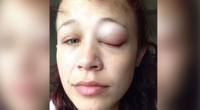 The 24-year-old said she went to hospital three times when her eye started to swell. Photo: Facebook