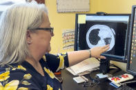 Dr. Lee Morissette shows an image of lungs damaged by asbestos exposure, at the Center for Asbestos Related Disease, Thursday, April 4, 2024, in Libby, Mont. The Libby area was contaminated by asbestos-contaminated vermiculite from a nearby mine that was shipped through by rail. The town has been largely cleaned up, but health officials say the long latency period for asbestos-related diseases means people will continue to be diagnosed with illnesses for years. (AP Photo/Matthew Brown)