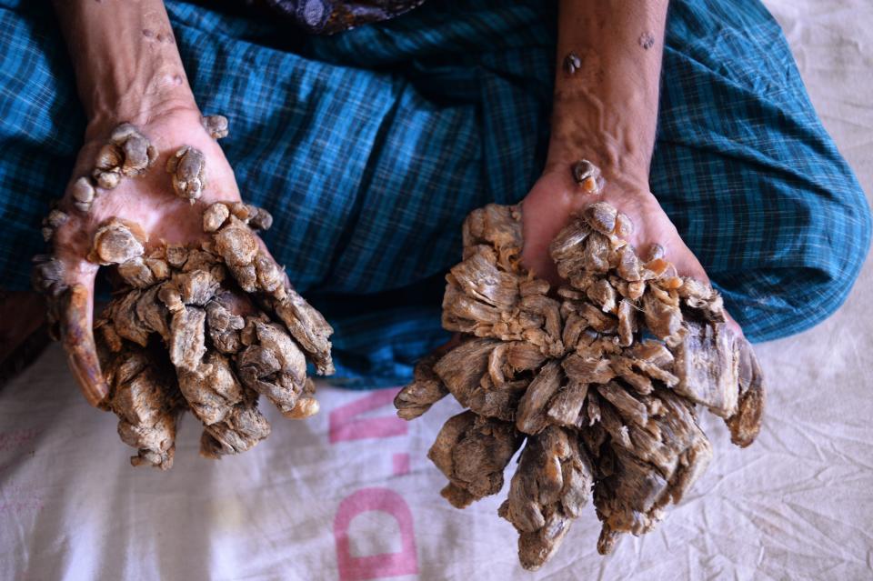 Abul Bajandar, 28, dubbed "Tree Man" for massive bark-like warts on his hands and feet, sits at Dhaka Medical College Hospital in Dhaka.