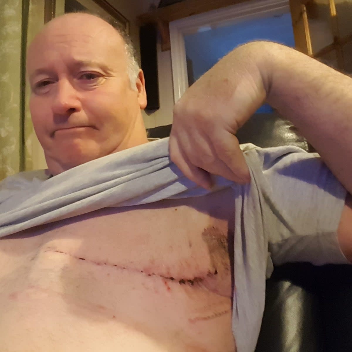 Mr Parker had a mastectomy and underwent chemotherapy (Supplied)