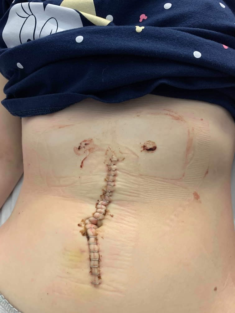 Pictured is the surgery scar on Taylor Battersby's stomach.