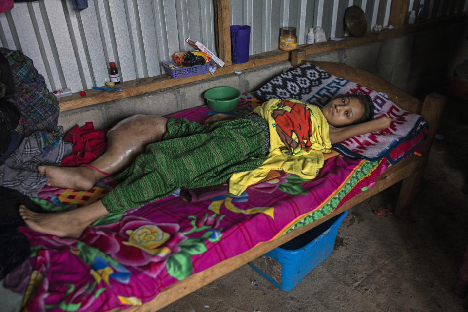 Flor Maribel Cal, 17, lies on her bed with a tumor on her right leg the size of a soccer ball in the makeshift settlement Nuevo Queja, Guatemala, Friday, July 8, 2021. Doctors said amputation was her only hope, her mother refused. She does not have the strength to take care of a daughter who will not be able to fend for herself. Flor died on July 22. (AP Photo/Rodrigo Abd)