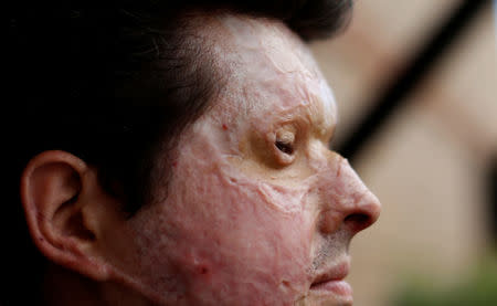 Acid attack victim Andreas Christopheros, poses for a photograph in his home in Truro, south-west England, Britain July 31, 2017. REUTERS/Peter Nicholls