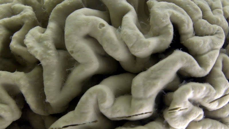 A section of a human brain with Alzheimer's disease is displayed at the Museum of Neuroanatomy at the University at Buffalo, in Buffalo, N.Y., Oct. 7, 2003. A long-feared gene appears to do more than raise people’s risk of Alzheimer’s: Inheriting two copies can cause the mind-robbing disease, according to research published in the journal Nature Medicine on Monday, May 6, 2024.