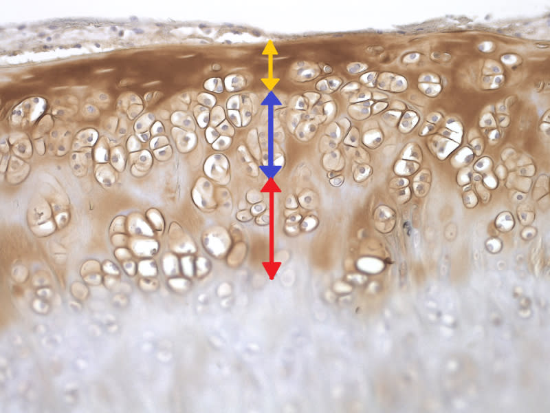 圖一：在大鼠的關節內多次注射雙功能肽(BiFP)遞送人類間質幹細胞，免疫組織化學檢測顯示棕色陽性信號處為新生的多層關節軟骨細胞，紅色、藍色、黃色分別為第一次、第二次、第三次施打的幹細胞。(圖/中國附醫)