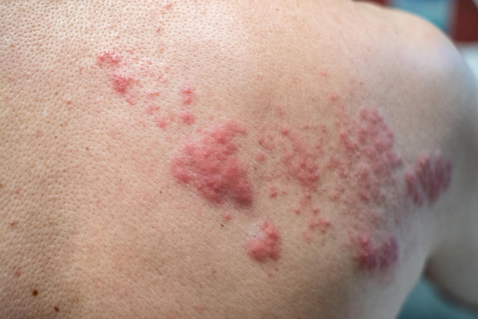 Shingles (herpes zoster) rash. (Image via Getty Images)