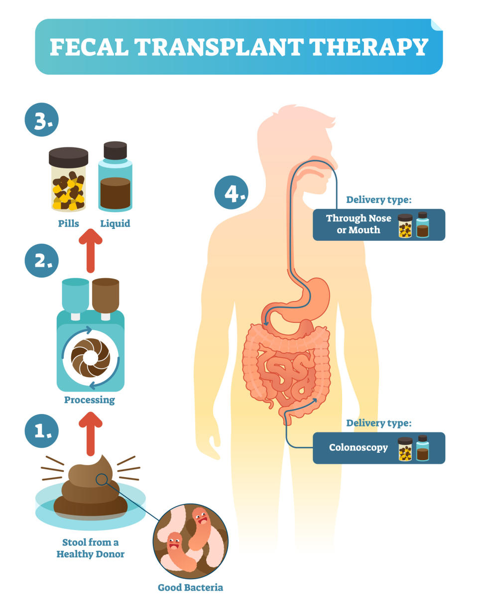 Infographic on fecal transplant therapy. Steps include stool from a healthy donor, processing, intake via pills or liquid, and delivery through the nose/mouth or colonoscopy