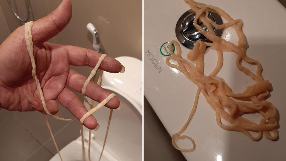 A man found a tapeworm after relieving himself, initially mistaking the parasite for string left over from a recent surgery. Source: Facebook.