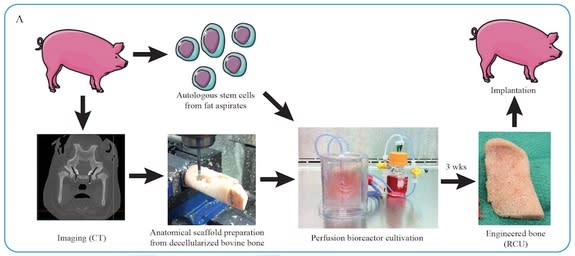 A diagram of the personalized bone tissue engineering process. In the study, bone scaffolds were seeded with stem cells derived from the fat of minipigs.