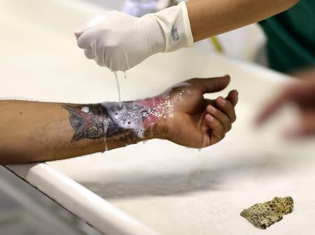 A nurse cleans a patient's hand after removing tilapia fish skin at Dr. Jose Frota Institute in the northeastern costal city of Fortaleza, Brazil, May 2, 2017. REUTERS/Paulo Whitaker/Files