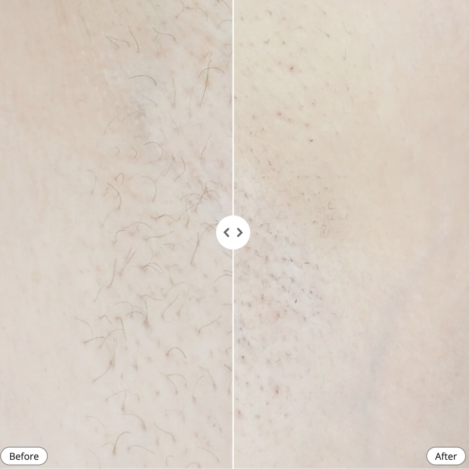 A user experienced good results after just 12 weeks of treatment. (PHOTO: Currentbody)