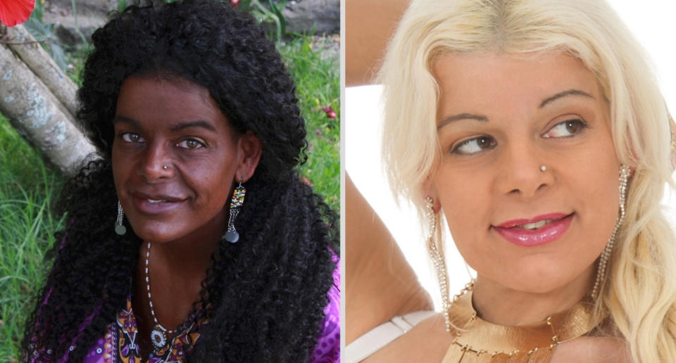 Desde 2017 se inyecta melanina para cambiar el color de su piel y pasar a ser negra. (Créditos: Getty)