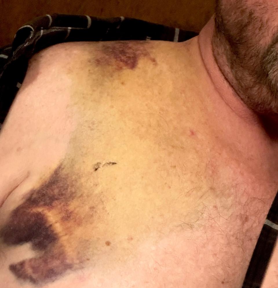 Tom Walker suffered seven broken ribs, a broken clavicle, a bruised lung, shoulder and hip, all on his left side, plus road rash on both elbows and his right knee as a result of the July 22 motorcycle accident.