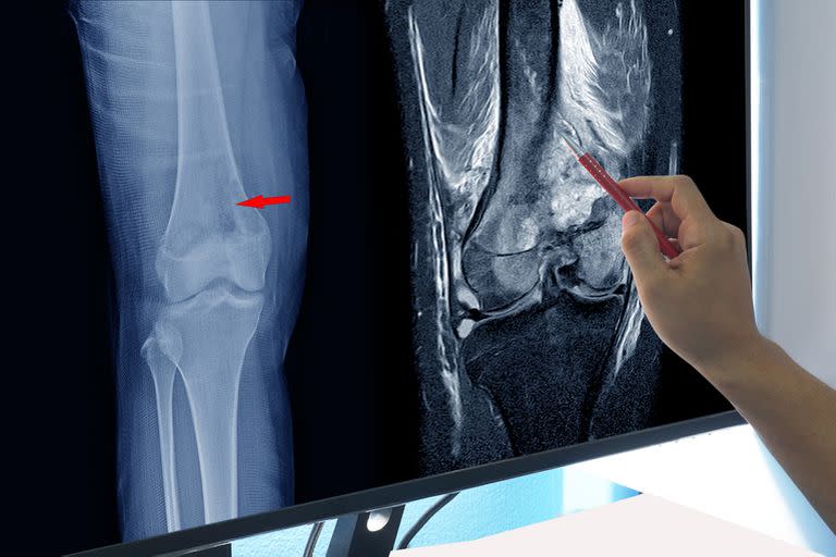 Magnetic Resonance Imaging (MRI) OF RIGHT KNEE Suggestive of malignant bone tumor, involving epiphysis and metadiaphyses of right distal femur, 
on hand doctor point,Medical healthcare concept.