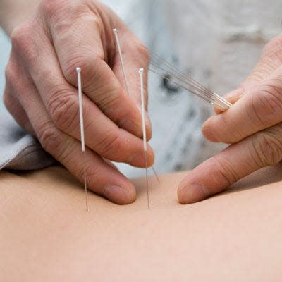 Dry needling has become a commonly used therapy for people who are experiencing muscle, ligament, or tendon pain that other therapies may not seem to relieve.