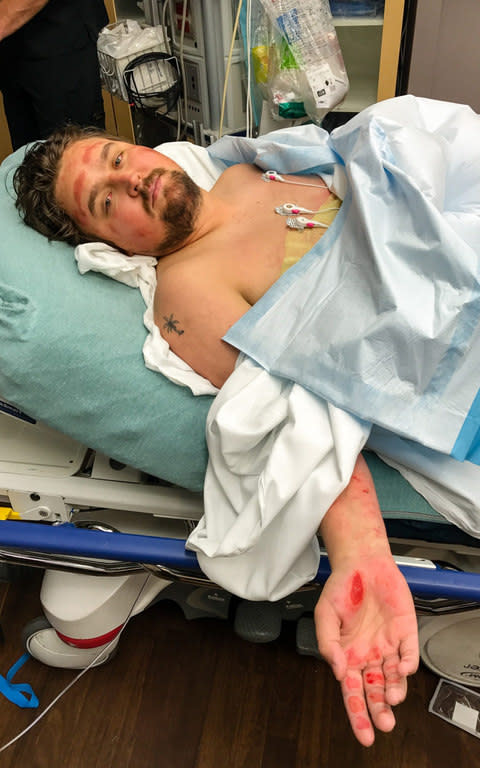  Ruaridh Connellan's hands are scarred from hours of clinging on for his life - Credit: Telegraph Credit: James Breeden