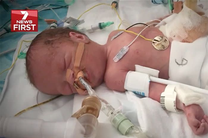 Little Konrad was born at 33 weeks with his intestines on the outside of his body and had three surgeries on his bowels within the first four days of his life. Source: 7 News