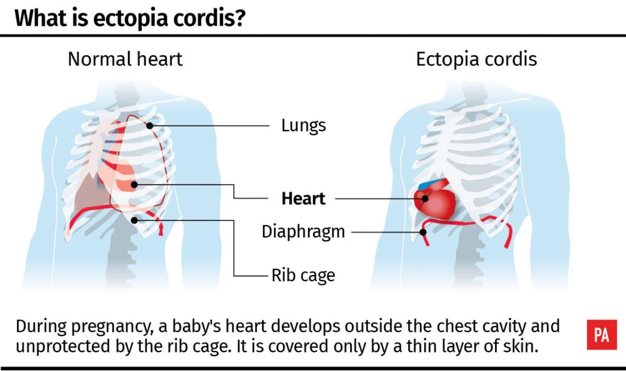 What is ectopia cordis?