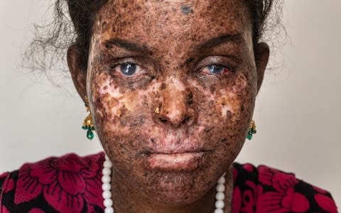 XP sufferer Sai Medha Bondagiri after receiving a cornea transplant - Credit: Simon Townsley/The Telegraph