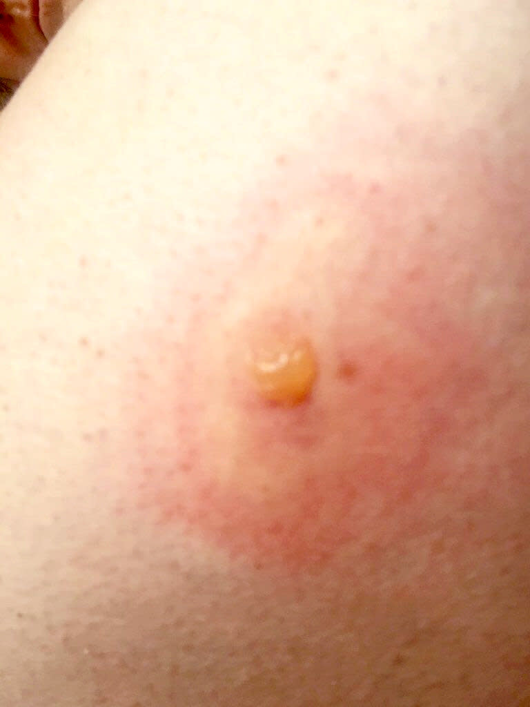 The spider bite needed to be drained three times. (SWNS)