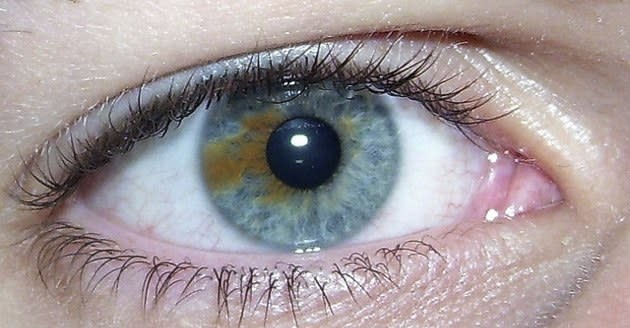 New laser surgery technique can turn your brown eyes blue