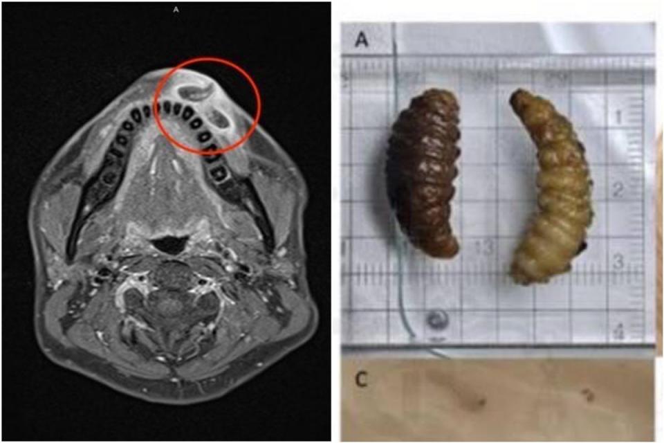 馬蠅寄生在嘴唇，經過手術取出3隻已孵化幼蟲。