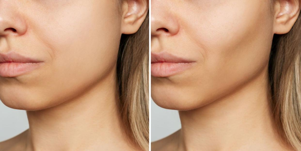 cropped shot of young woman's face before and after plastic surgery buccal fat pad removal result