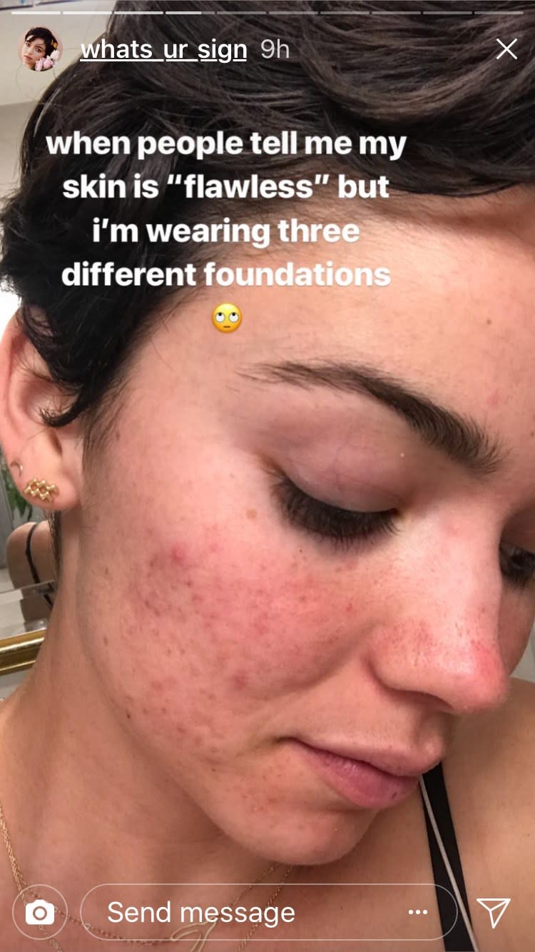 Find out what "Bachelor" contestant Bekah Martinez had to say about fans complimenting her "flawless" skin with a selfie on Instagram.