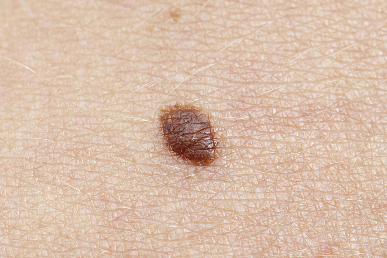 Skin conditions and photos of basal cell carcinoma (jax10289 / Getty Images stock)