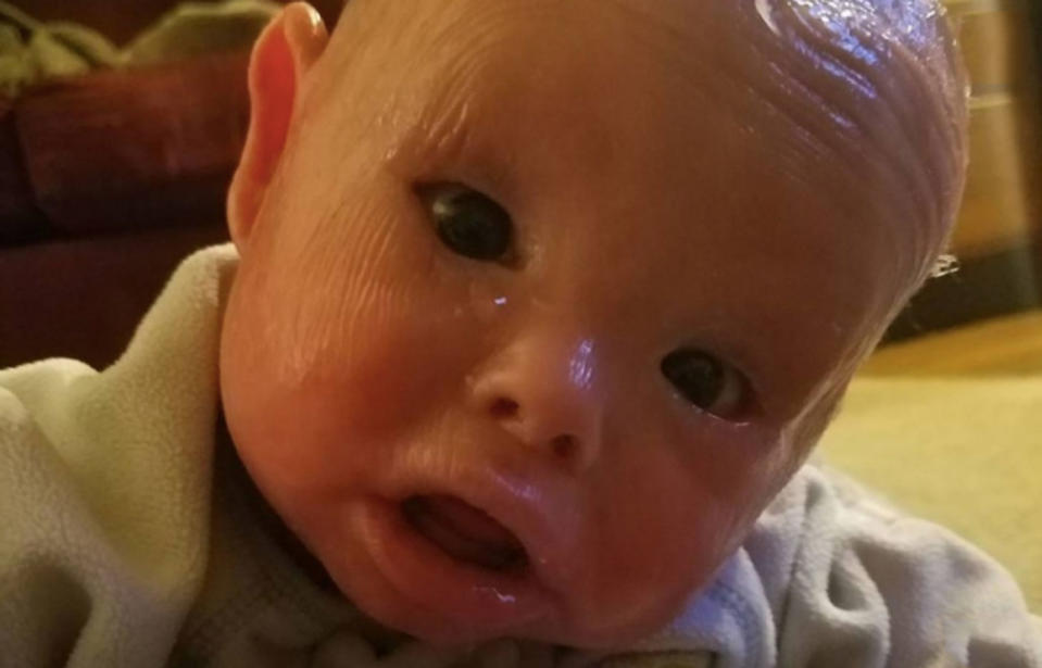 Jamison suffers from a rare skin condition called Harlequin Ichthyosis. Source: GoFundMe