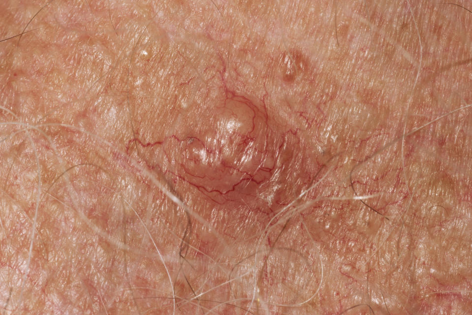 up close picture of Basal cell carcinoma flesh bump skin cancer