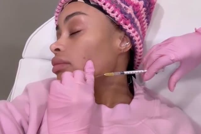 <p>Blac Chyna/Instagram</p> Blac Chyna gets her facial fillers dissolved