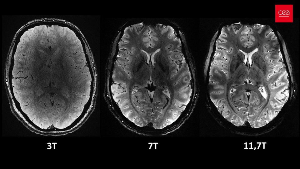 Three brain scans from different powered MRIs, with the least detailed at the left and the most at the right