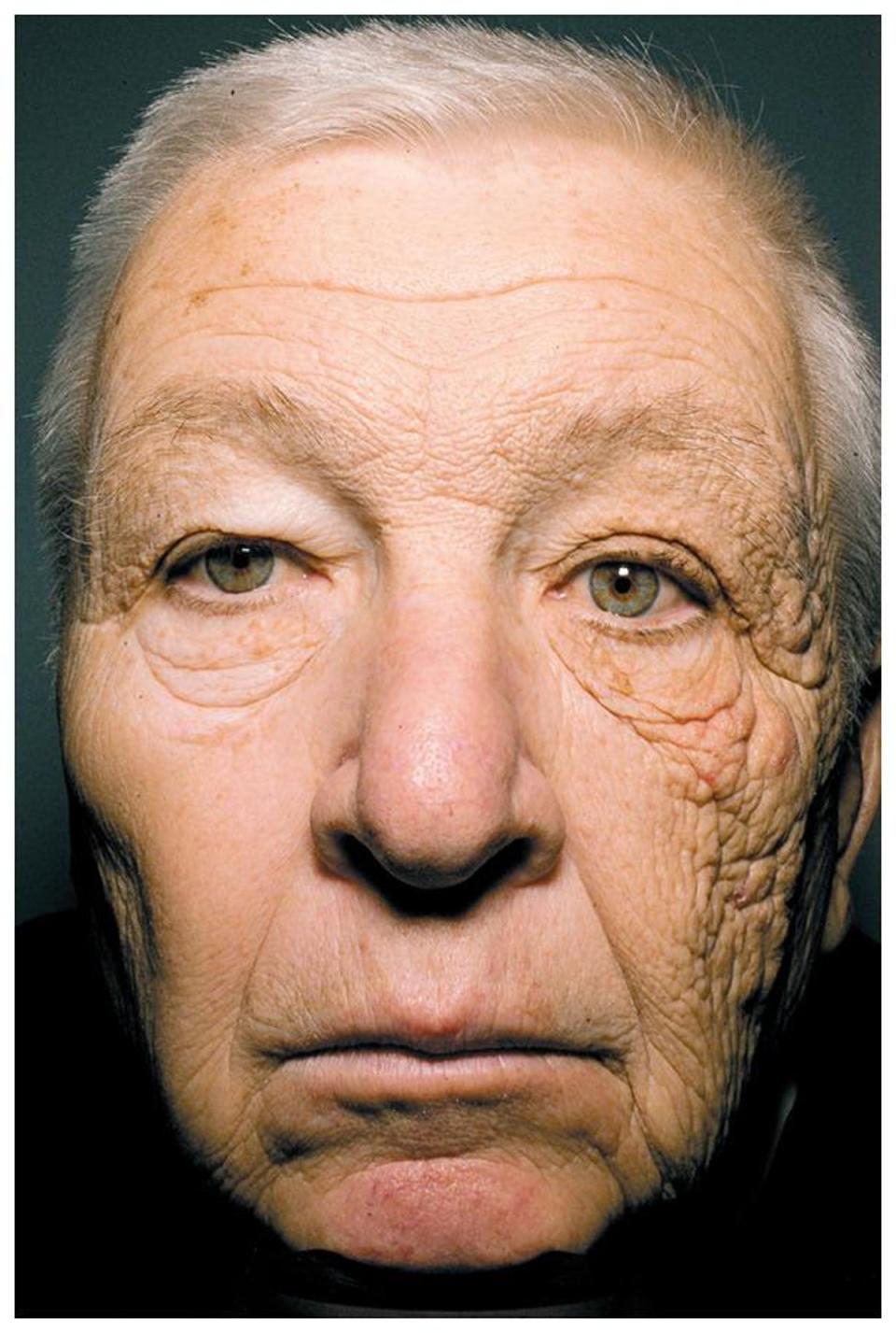 (New England Journal of Medicine)The jarring effects of UV radiation