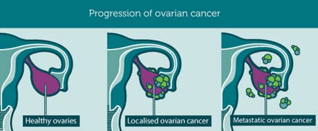 There are no effective tests for early ovarian cancer screening and symptoms are very subtle. 