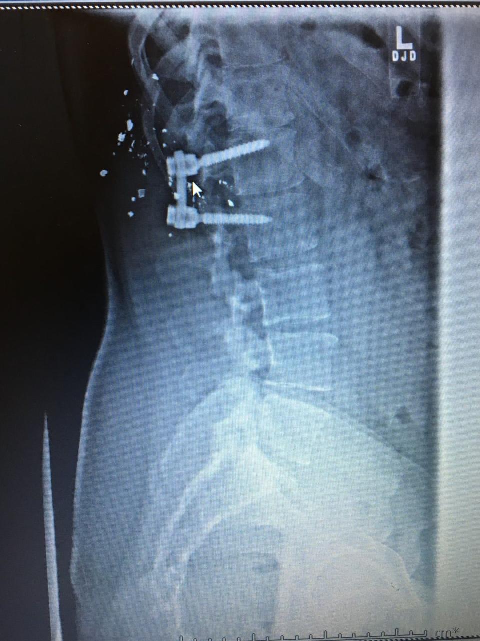 This X-ray shows where shrapnel remains in Robert Aguilar's back from the gunshot wound he sustained in the mass shooting in Las Vegas on Oct. 1, 2017.