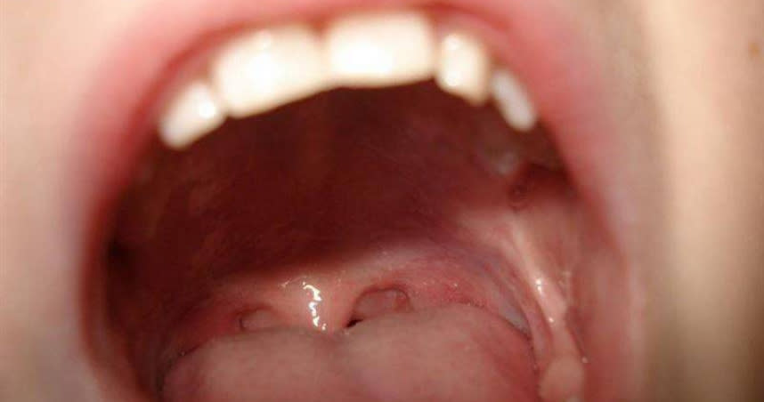老公口臭嚴重，原本以為是扁桃腺結石，結果竟然是口腔舌癌。（示意圖／翻攝自Pixabay）