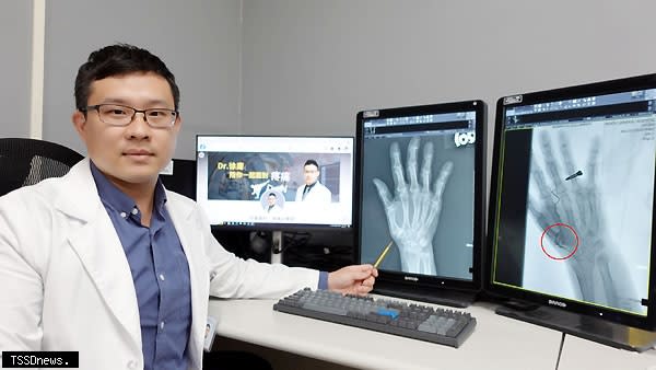 部苗放射科主任徐庸醫師透過X光影像，指出患者右手拇指基底關節已明顯退化和變形，此處即為本次疼痛治療目標。