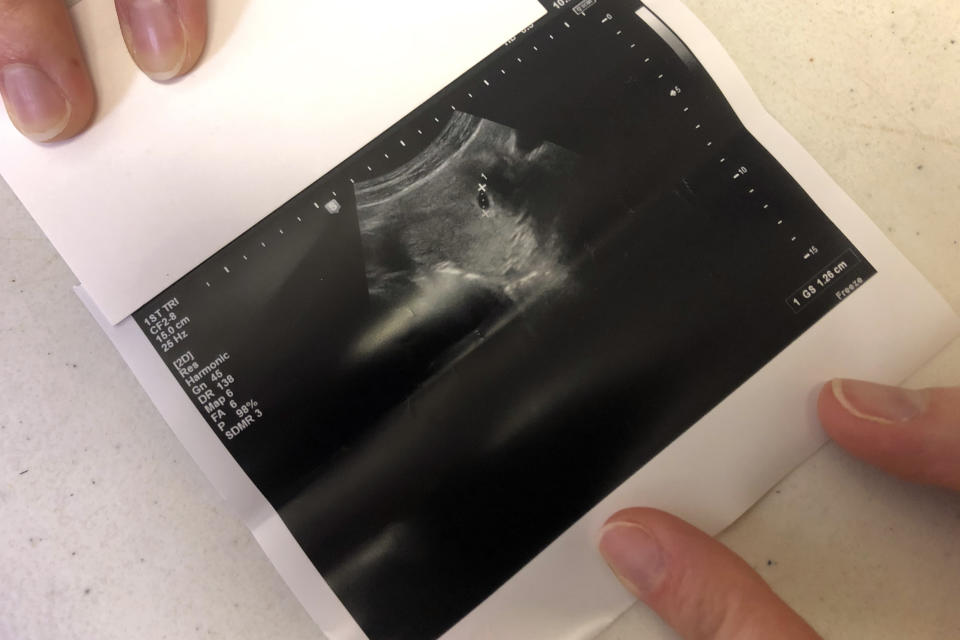 The ultrasound of a woman who went to the Hope Medical Group for Women on Feb. 20, 2020, in Shreveport, La. The clinic is one of three in the state that provides abortions to women, and it is challenging a state law that requires doctors who perform abortions to have admitting privileges at a nearby hospital. The Supreme Court is hearing the case on March 4. (AP Photo/Rebecca Santana)