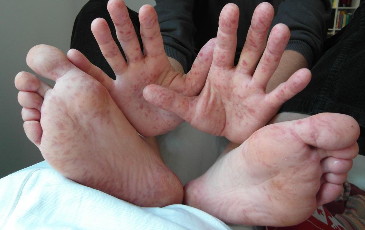 hand foot and mouth disease identification