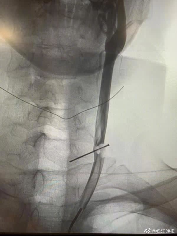 男子頸動脈插了一根3公分鐵釘。（圖／翻攝自錢江晚報）
