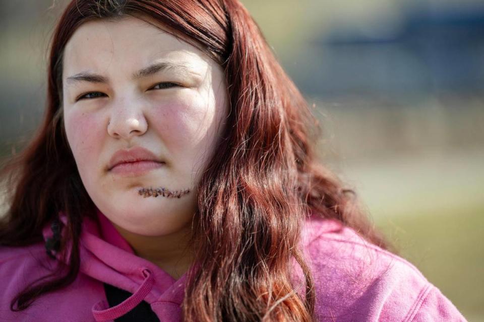 Mireya Nelson, 15, of Belton, Missouri, was shot during the Chiefs Super Bowl Rally last week at Union Station. She stopped by the memorial for the shooting victims in the parking lot of Union Station on Wednesday, Feb. 21, 2024, on her way to a doctor’s appointment at Children’s Mercy Hospital. Mireya sustained a gunshot would through her jaw which traveled into her shoulder. Tammy Ljungblad/tljungblad@kcstar.com