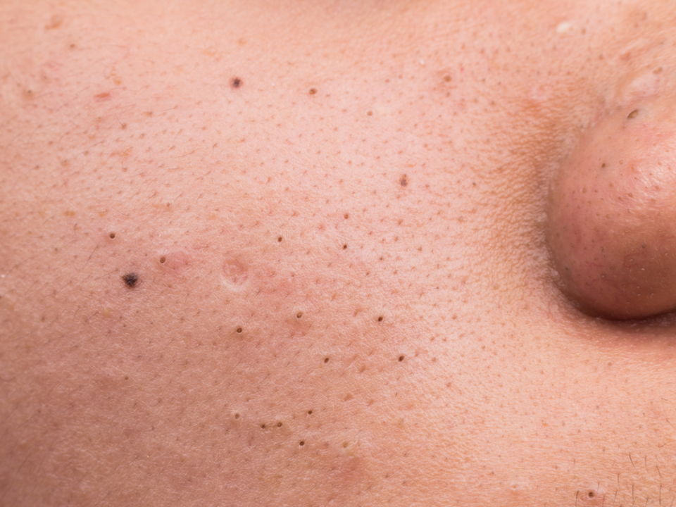 Blackheads