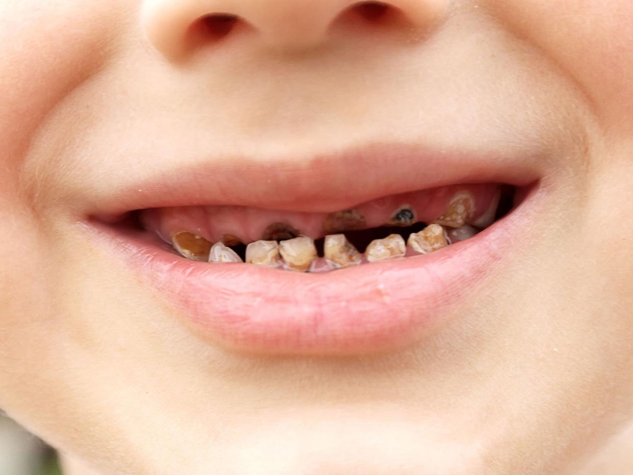 Soaring rates of tooth extractions and obesity in children have been linked to sugar: Alamy